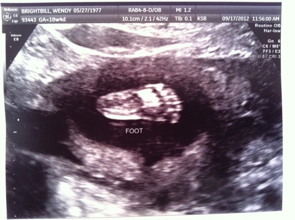 ultrasound foot
